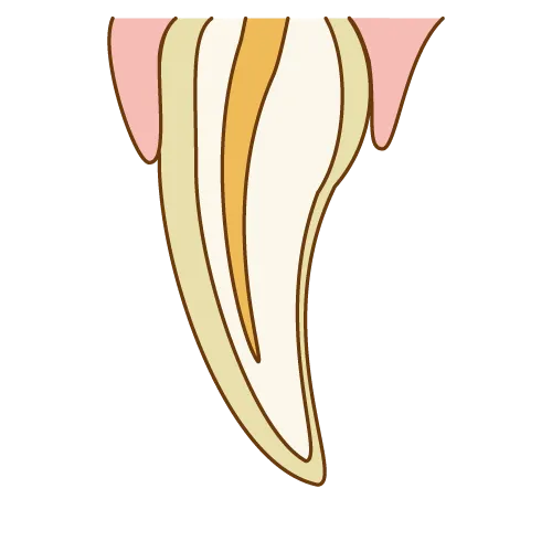 ラミネートベニア手順01