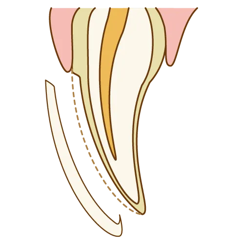 ラミネートベニア手順02