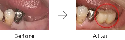 インプラント症例1