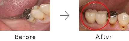 インプラント症例2