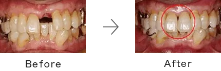 インプラント症例3