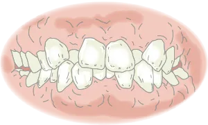 叢生（そうせい）