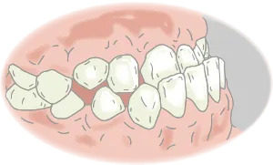 下顎前突（かがくぜんとつ）