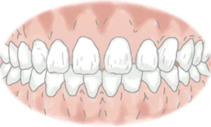 空隙歯列（くうげきしれつ）