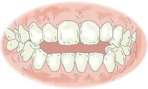 開咬(かいこう)