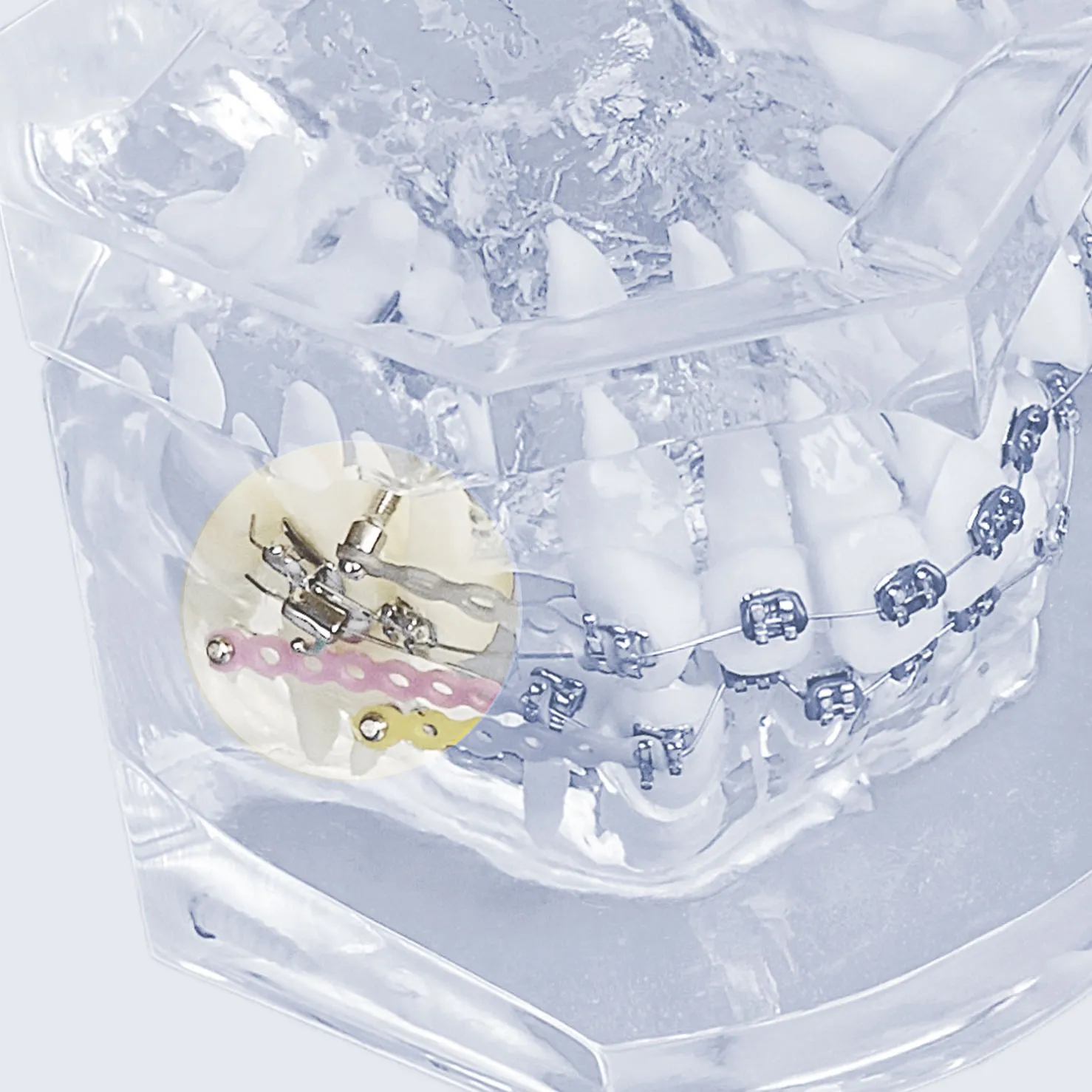 矯正用アンカースクリュー