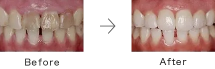 ホワイトニング症例1