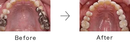 ホワイトニング症例2