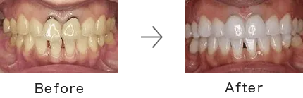 ホワイトニング症例3