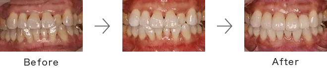 ホワイトニング症例4