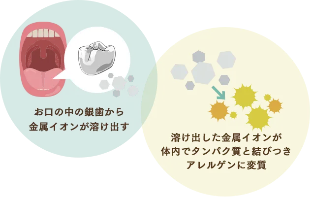 金属アレルギーのメカニズム