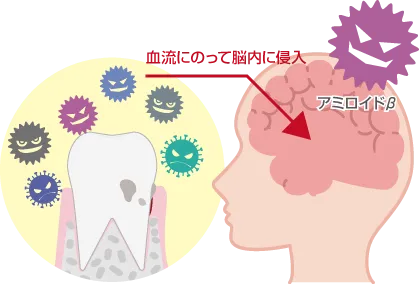 歯周病がアルツハイマー型認証の原因となる理由図解
