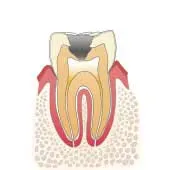 イラスト図：虫歯C3