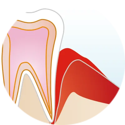 腫れている歯茎
