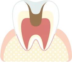 神経に到達した虫歯