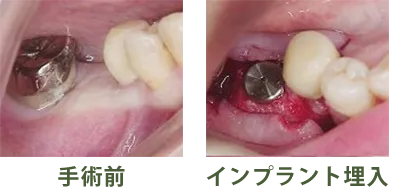 手術前・インプラント埋入