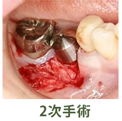 二次手術