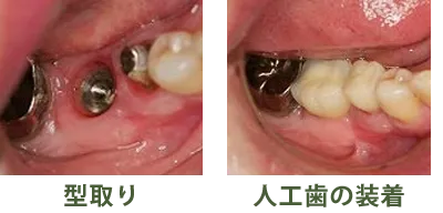 型取り・人工歯の装着
